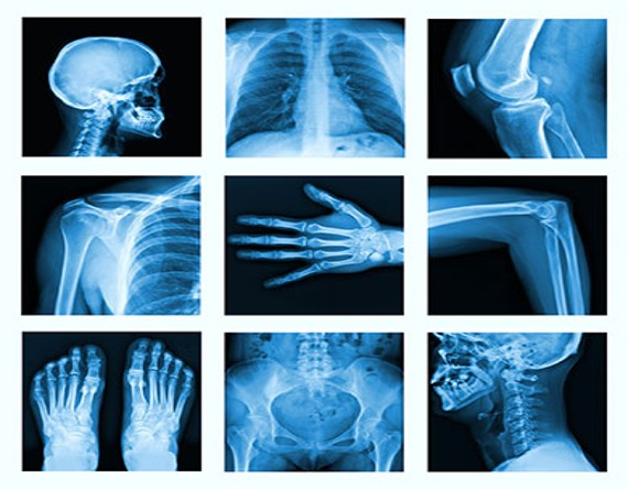 X-Ray in Meghalaya